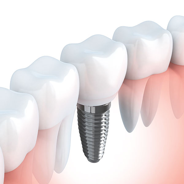 人工植牙